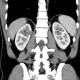 Cystic nephroma, Perlmann's tumour: CT - Computed tomography